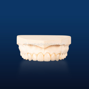 Advanced na Dental Emax Onlays para sa Pagpapanumbalik